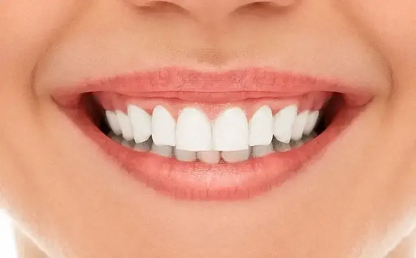 The same smile after whitening